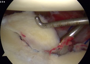 glenoid