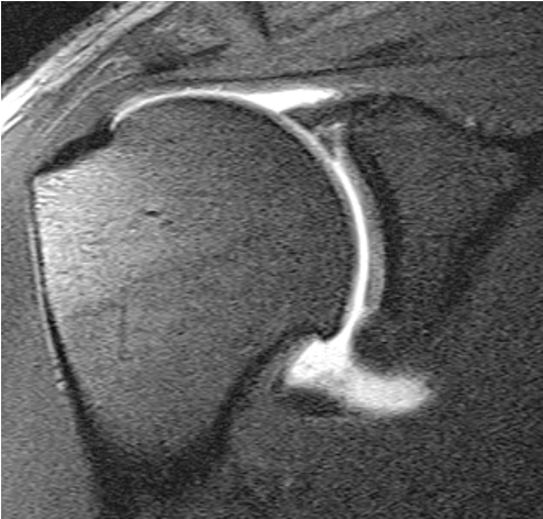 labral cyst