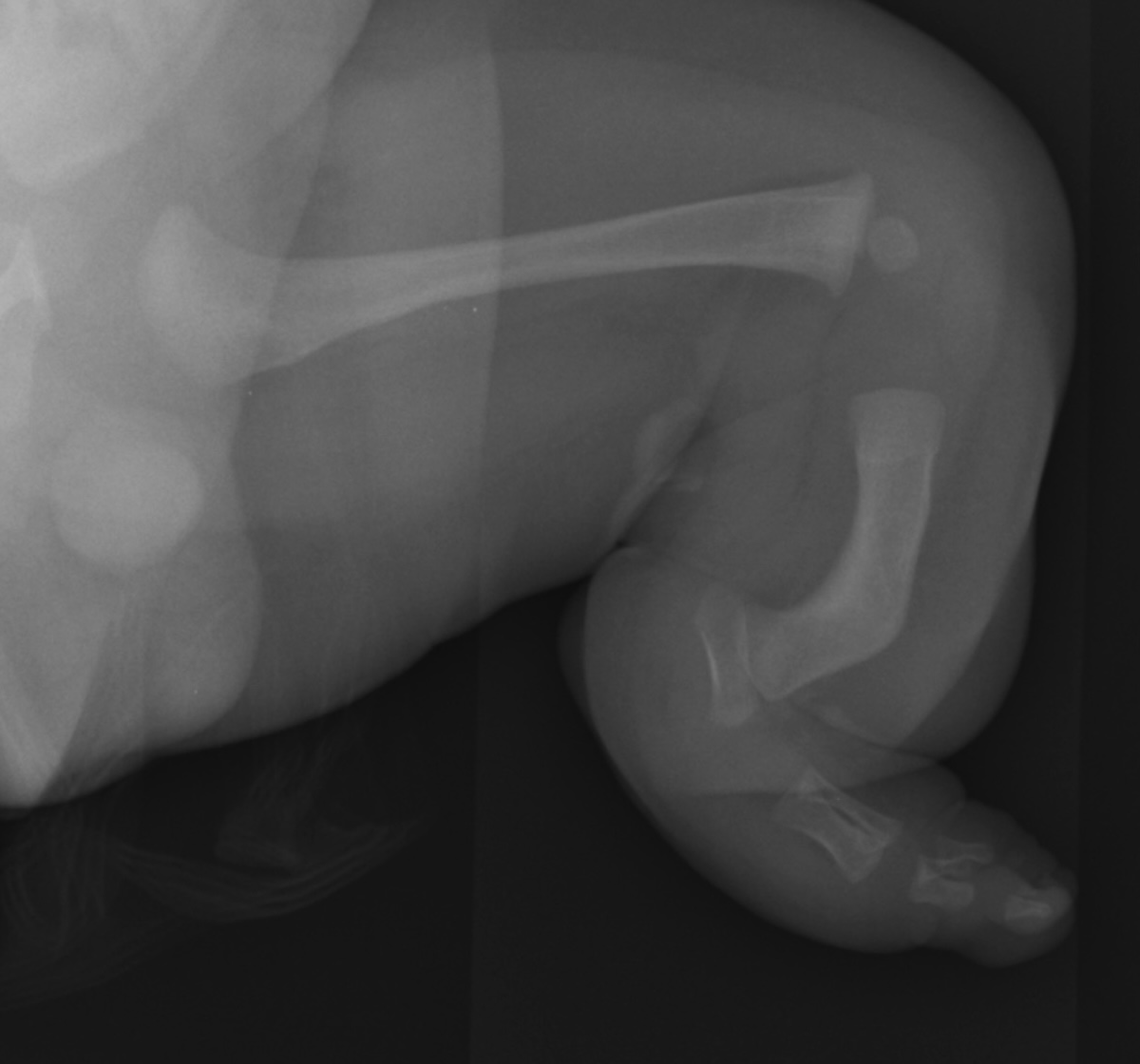 fibular hemimelia
