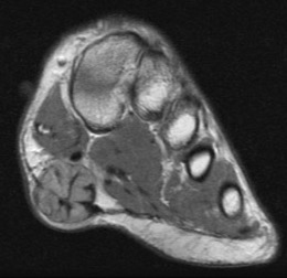 fibroma