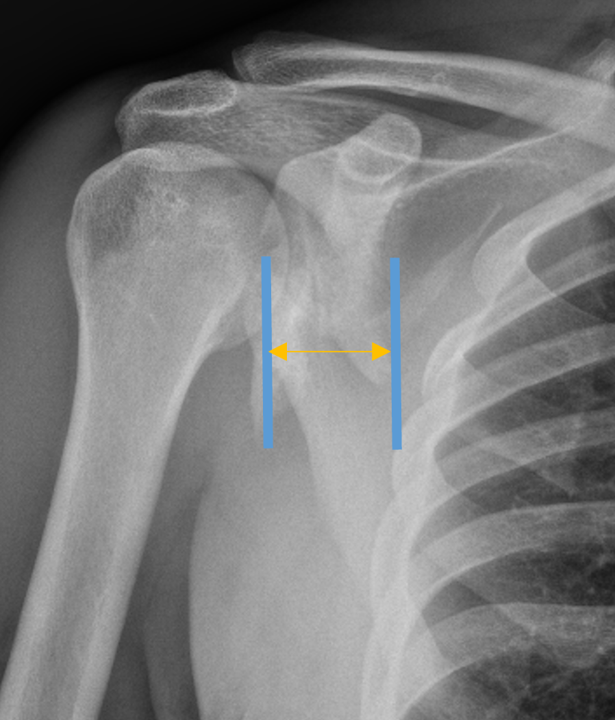 Scapula