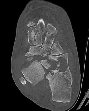Charcot