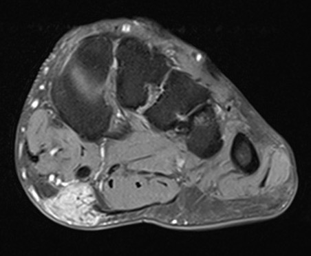 fibroma