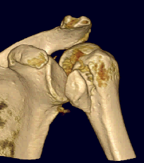 LT fracture
