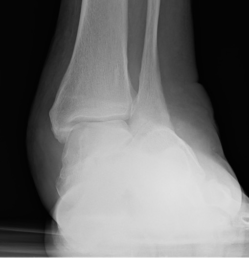 Charcot
