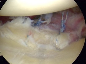 glenoid