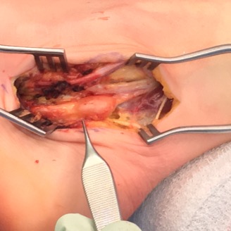 Schwannoma