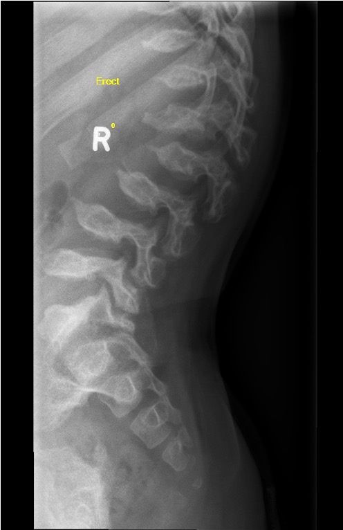 platyspondyly
