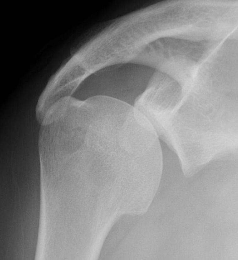 post shoulder