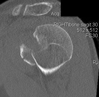 LT fracture