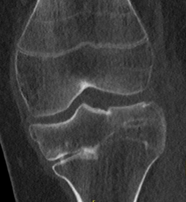 Angular deformity growth plate arrest