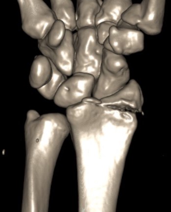 radial styloid
