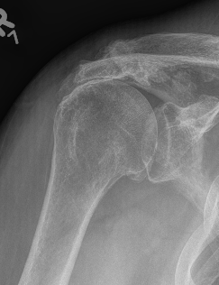RC arthropathy