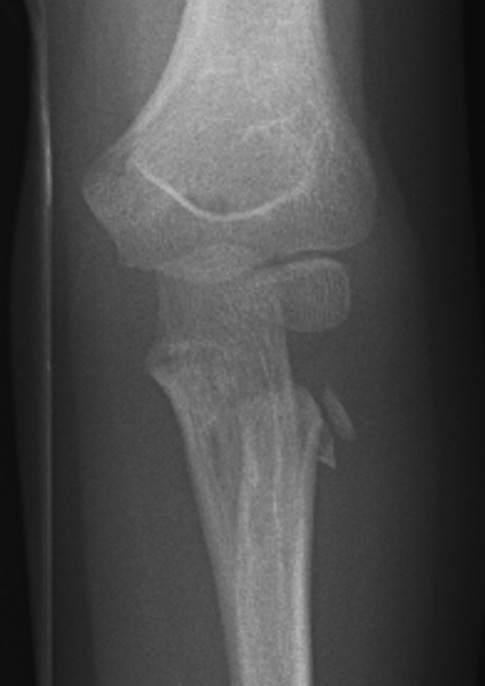 radial neck
