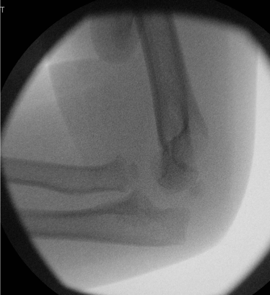 Radial neck