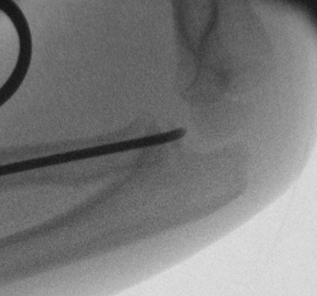 radial neck