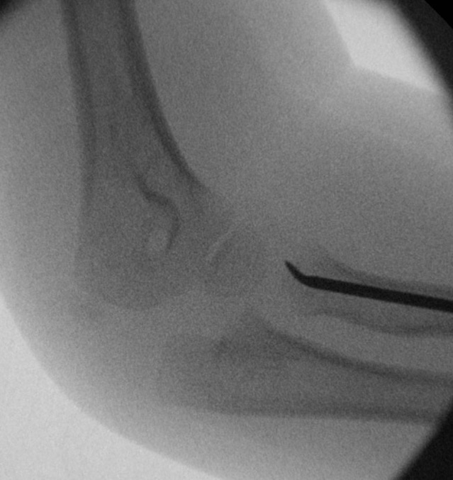Radial neck