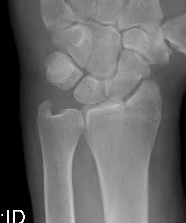 Radial styloid fracture
