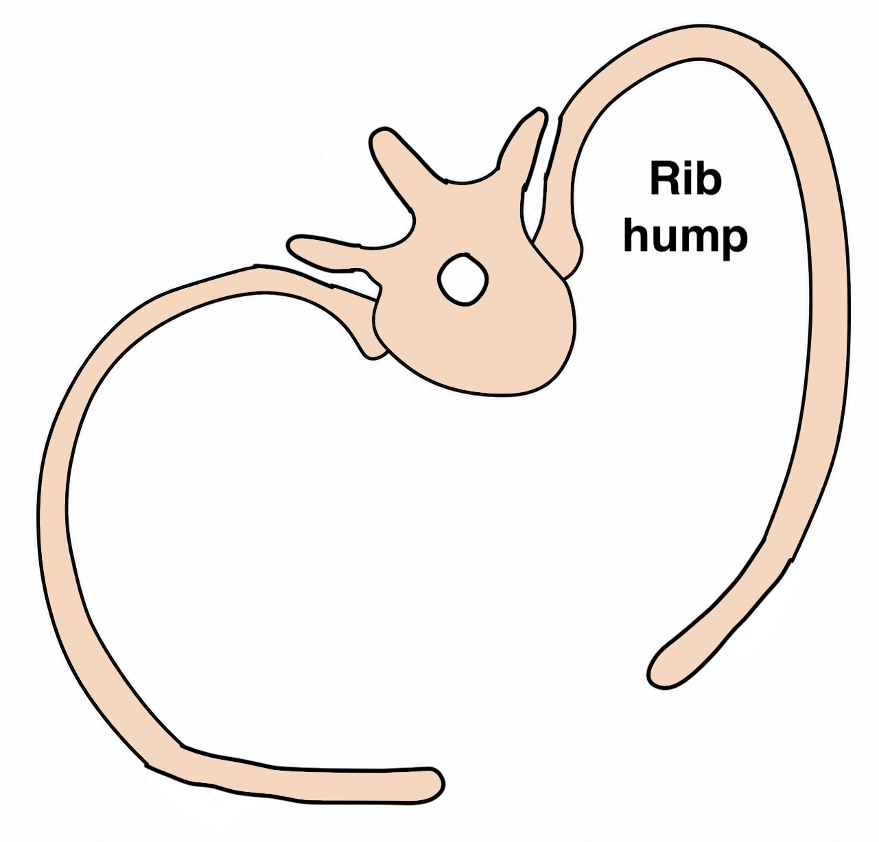 rib hump