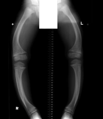 Rickets