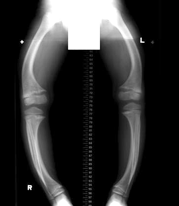 Rickets
