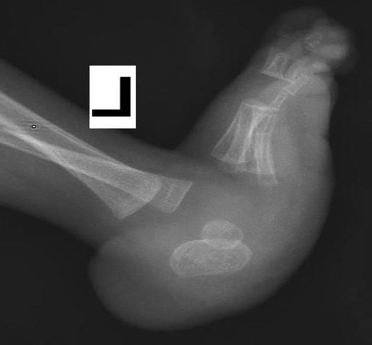 CVT