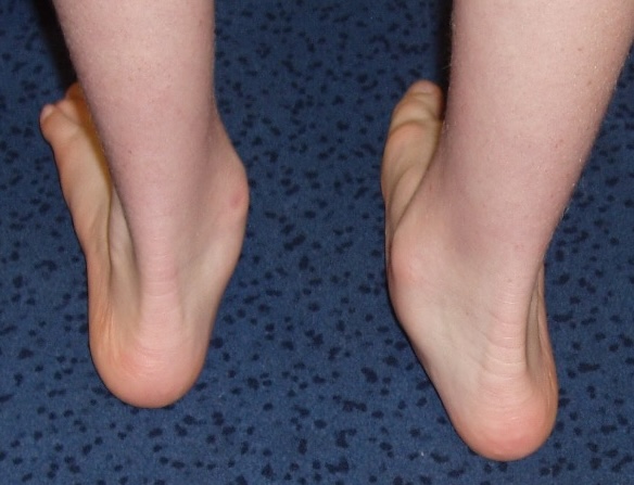 Spina bifida