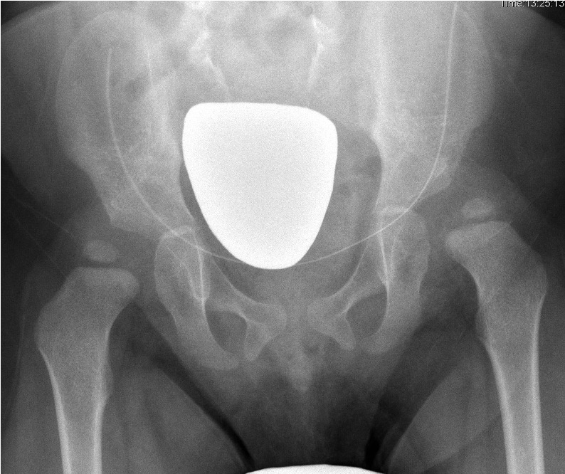 Spina bifida hip