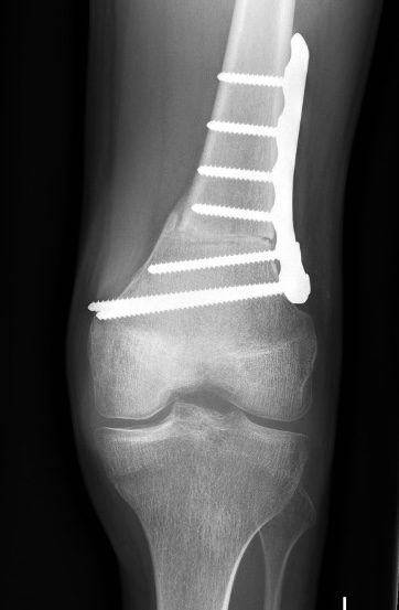 Spina bifida knee