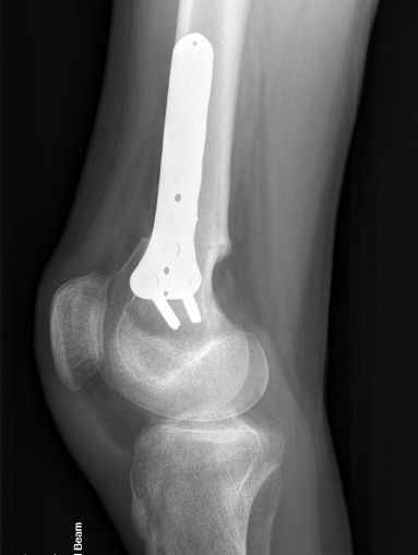 Spina bifida knee