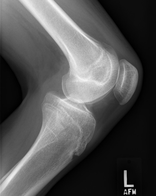 Spina bifida
