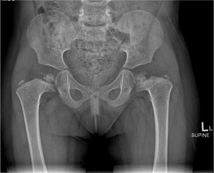 SED fusion occipital