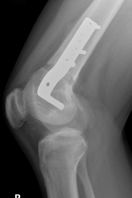 dis femur