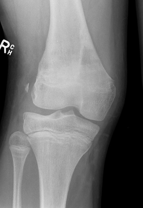 Distal femur