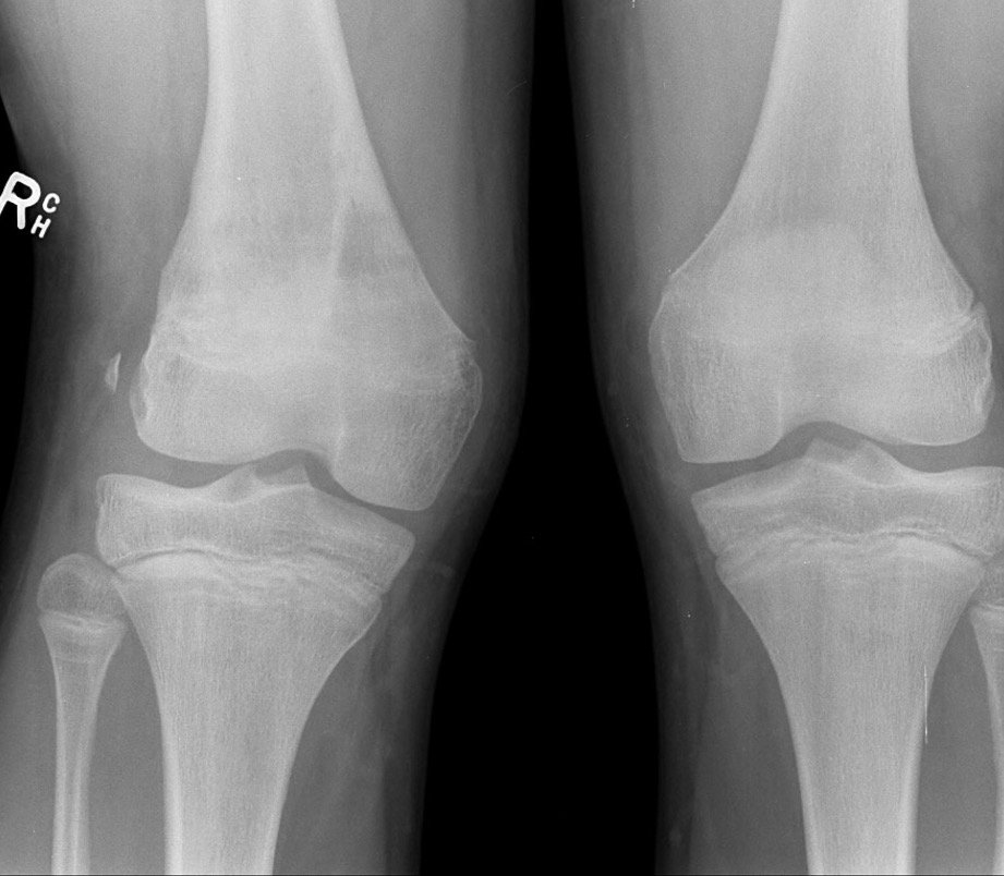 angular deformity
