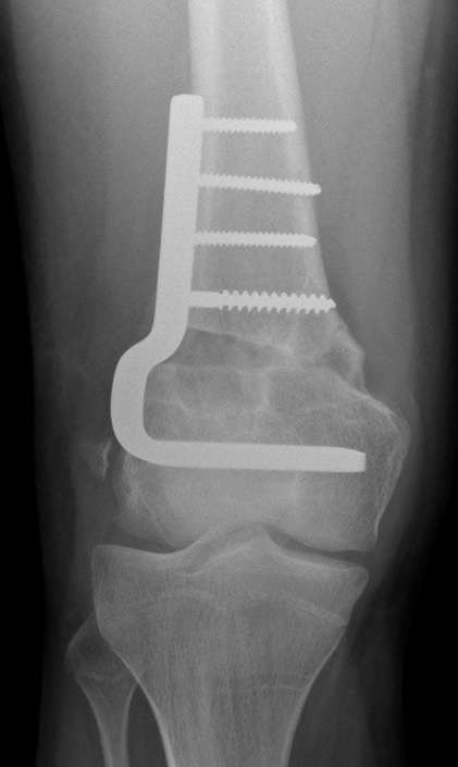 dis femur