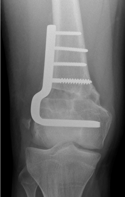 valgus