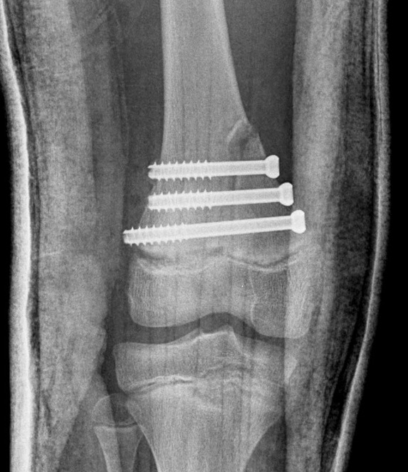 dis femur