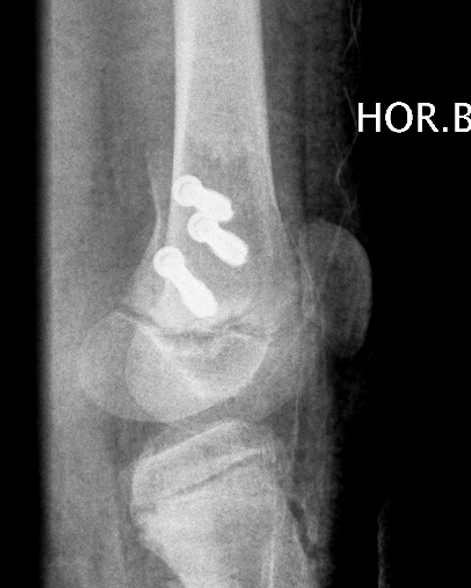 dis femur
