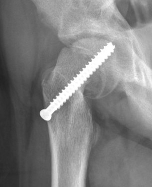 intra articular