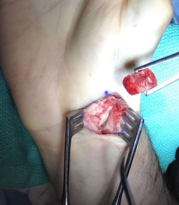 scaphoid nonunion