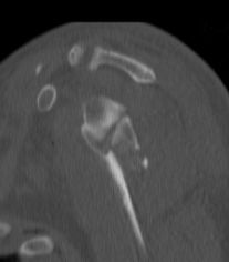 glenoid