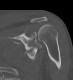 glenoid