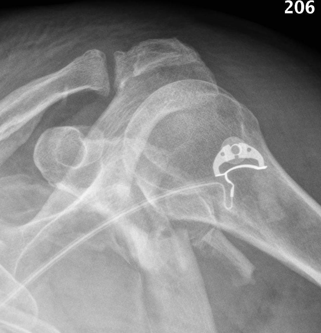 glenoid