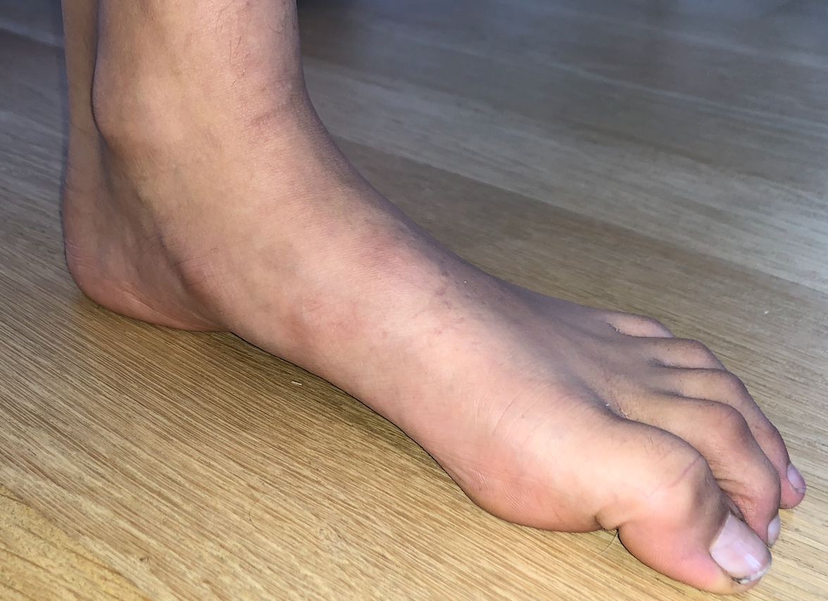 Flat feet