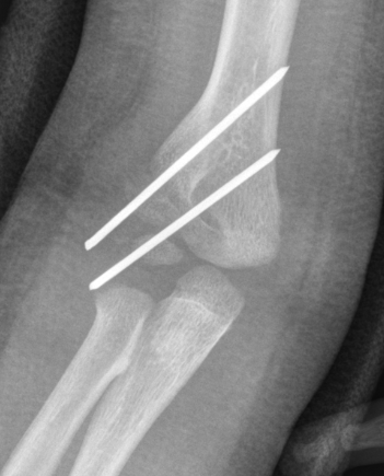 Distal physeal