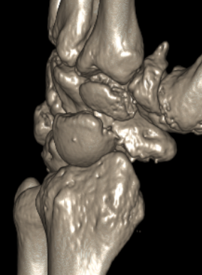 scaphoid