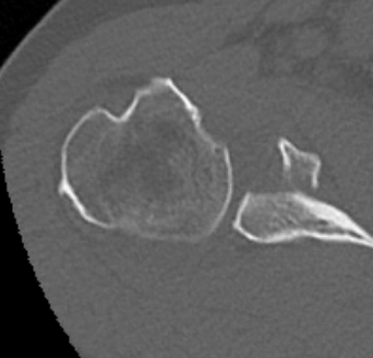 glenoid
