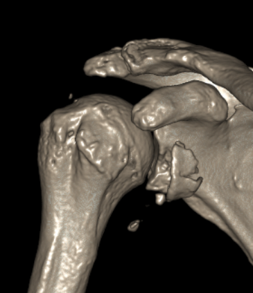 glenoid