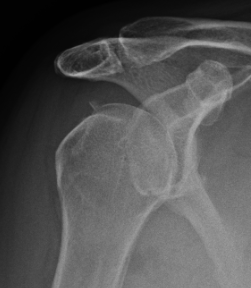 glenoid